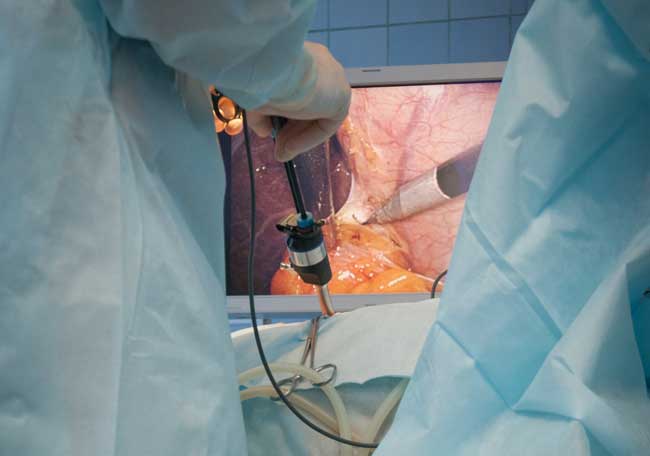 Cirugía anti reflujo precio 