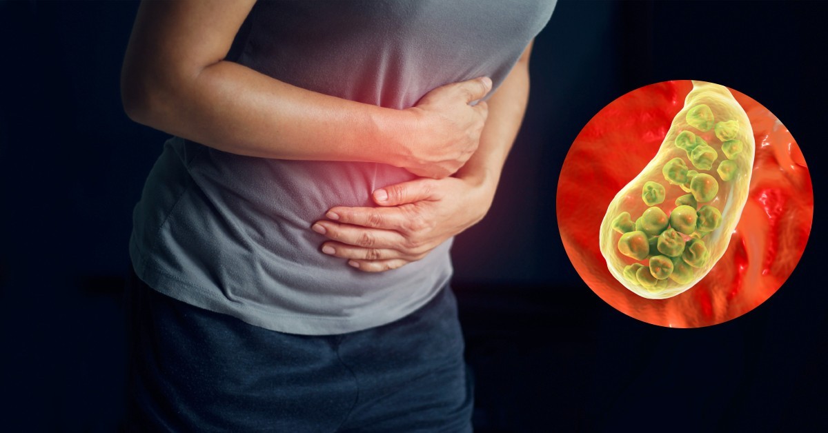 Operación de vesícula precio