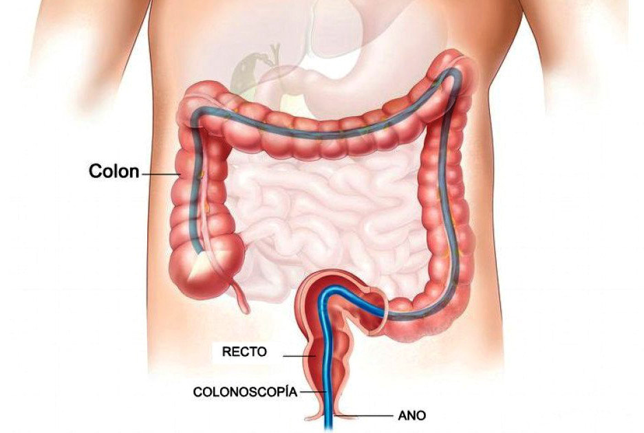 Precio de colonoscopia en  benito juarez