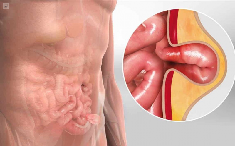 Precio reparación de hernia por laparoscopia